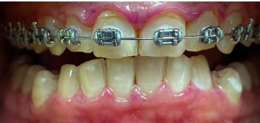GBT (Guided Biofilm Therapy)